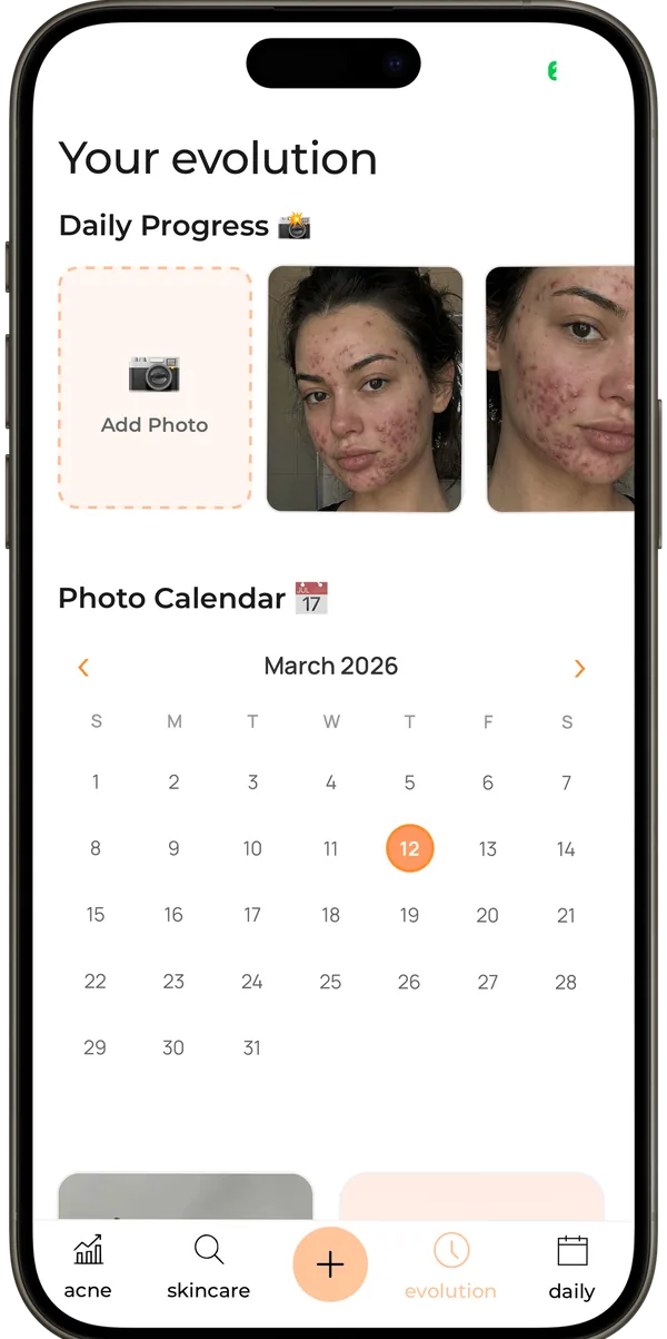 AcneTrack evolution tab charting acne score improvement week by week from progress photos