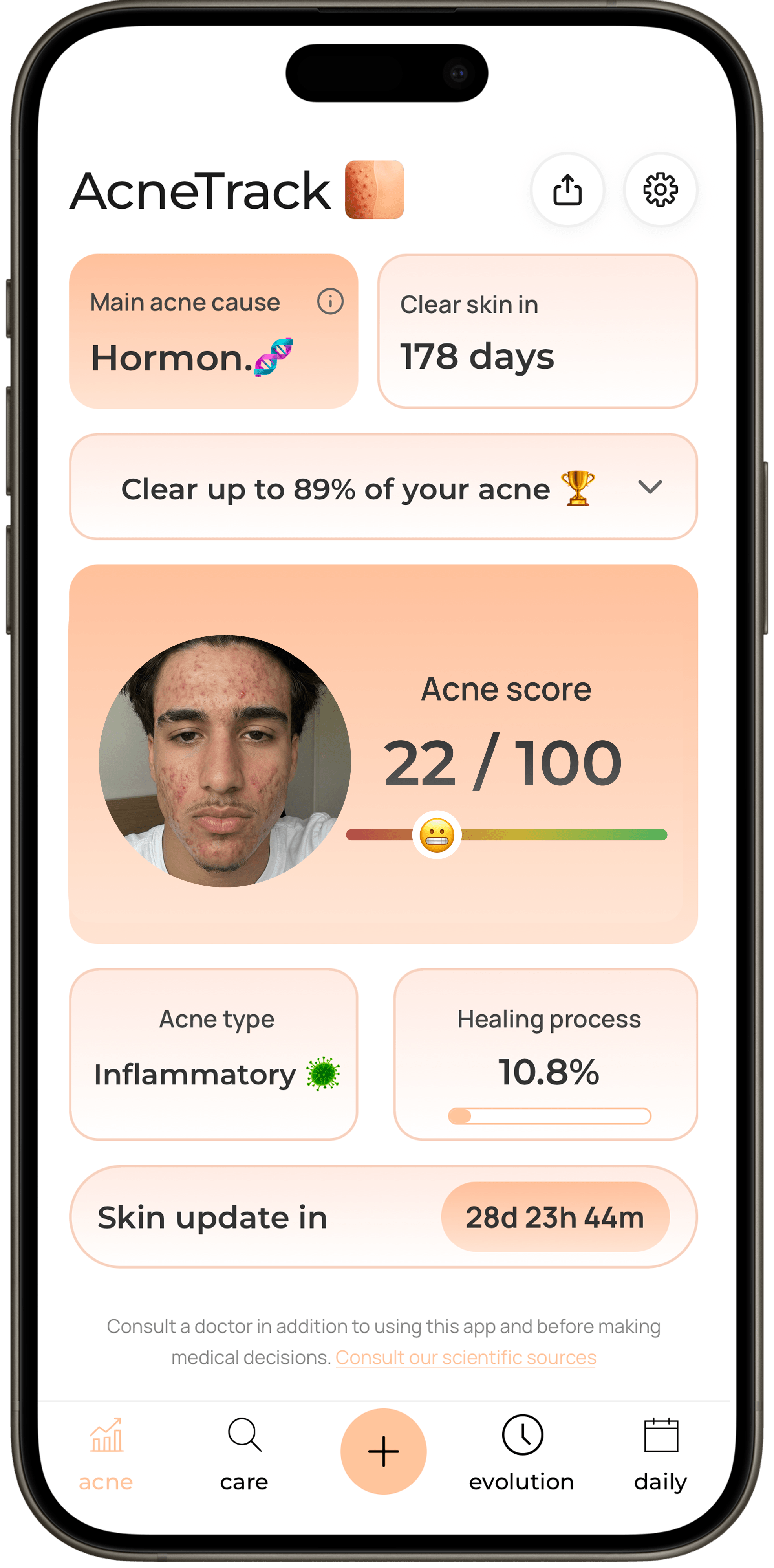AcneTrack — acne score dashboard
