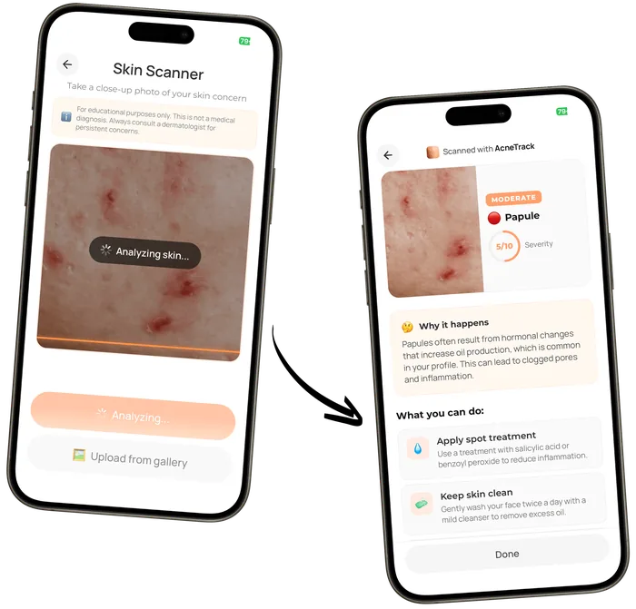 AcneTrack Pimple Scan analysing a close-up photo of a spot and returning its type and severity